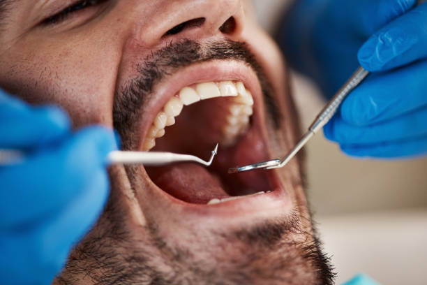 Best Wisdom Tooth Removal  in Charleston, MS